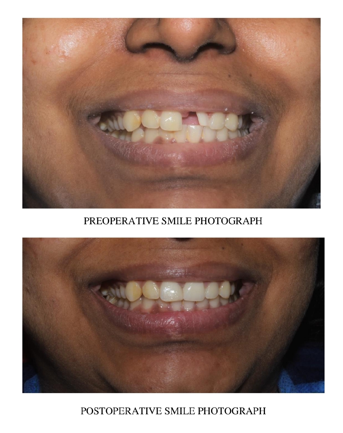 Smile makeover - Before and After